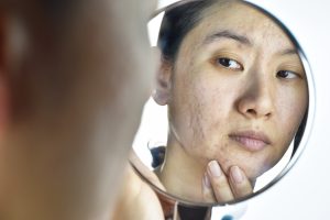 Acne Scar Treatment, best scar treatment, acne scars