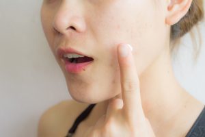 skin care treatments for acne