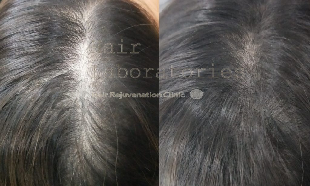 The List Of Hair Loss Treatments In Singapore to Solve Your Thinning  Hairline Woes