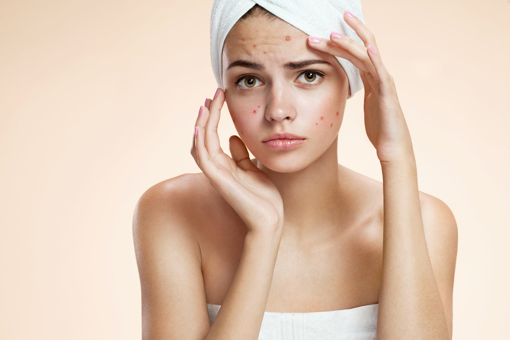 acne skincare habit