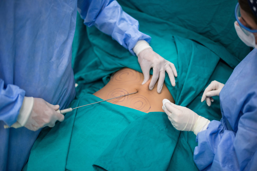 How Does Liposuction work in David Loh Surgery