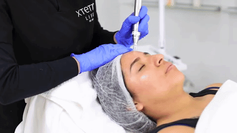 Microneedling In Singapore: The Only Guide You'll Ever Need