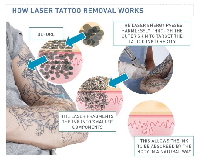 Laser Hair Removal (Clarity II) • Skinscape Clinic