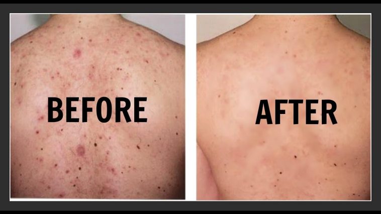 back acne scars