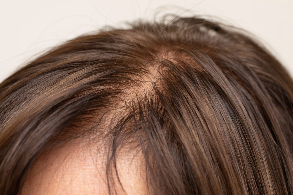 woman with thinning hairline