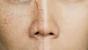 freckles removal singapore,