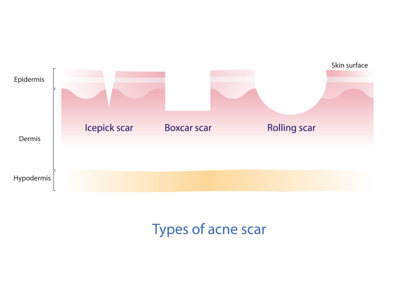 Find The Best Treatment For Ice Pick Scars In Singapore