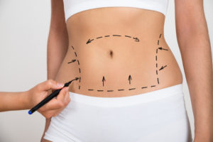 liposuction in singapore