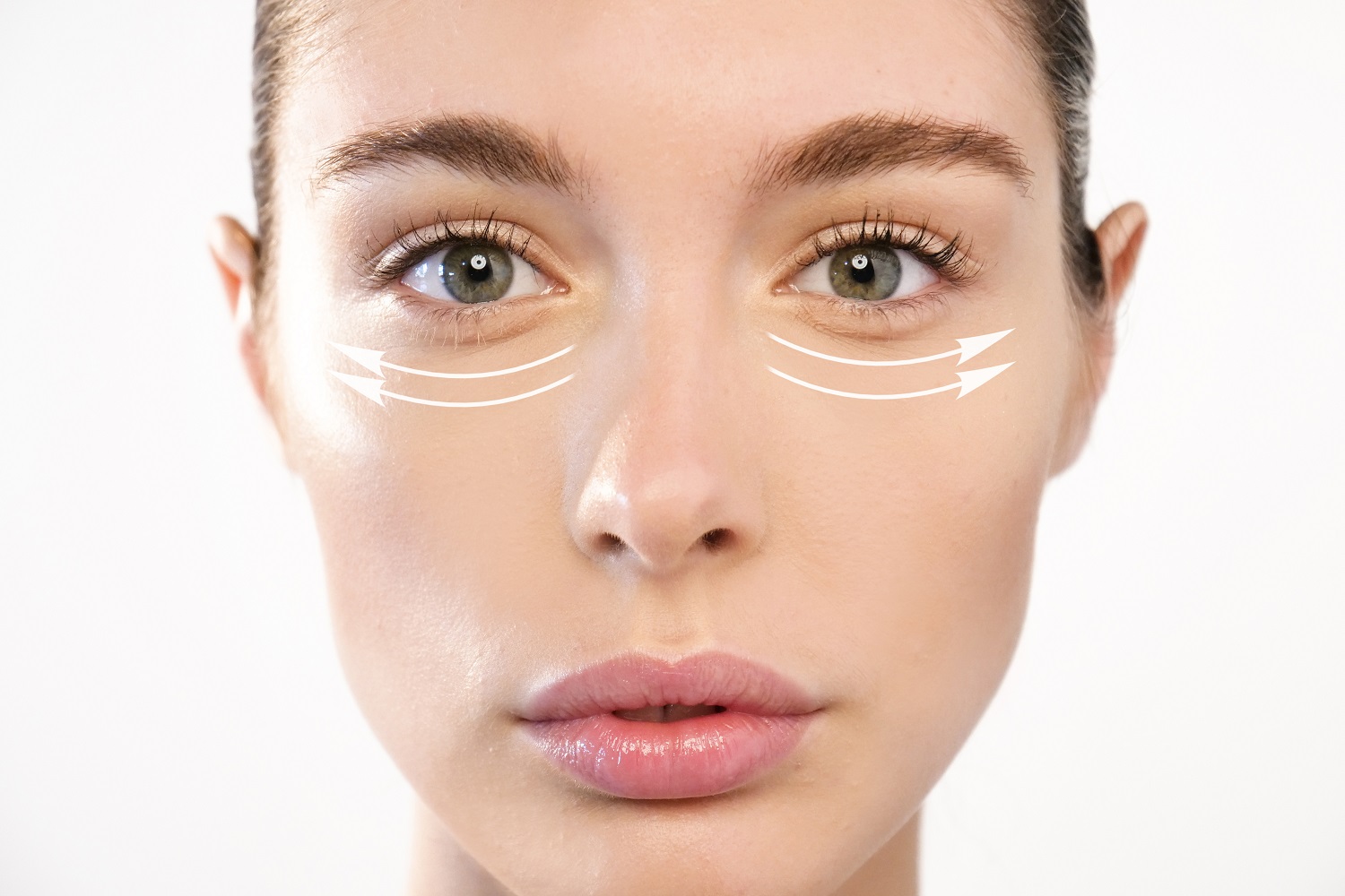 Why Lasers or PRP Under Eyes Dont Work for Puffy Eye Bags