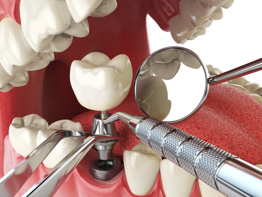 what-are-dental-implants