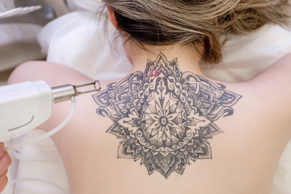 Regret Getting A Tattoo? Here's Everything You Need to Know About Laser Tattoo Removal
