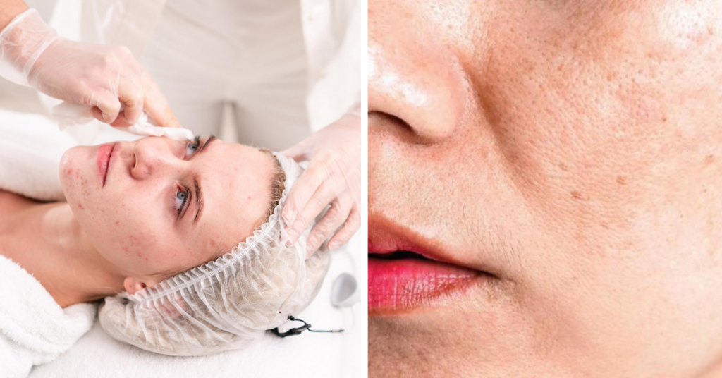 13 Medi-Spa Clinics In Singapore That Specialises In Acne, Wrinkles & Pigmentation Laser Treatment